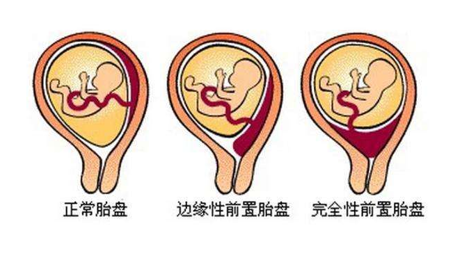 归纳起来和胎盘的大小