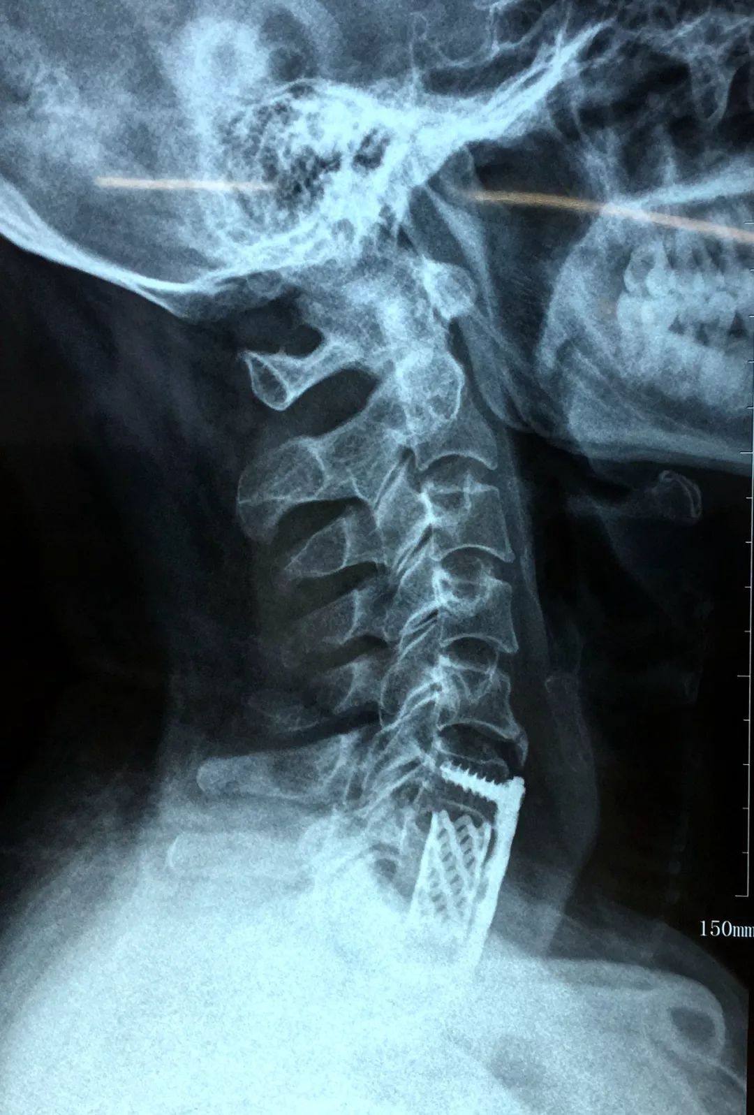 c7左侧椎板及左侧关节突骨折,c6双侧椎板多发骨折,c5棘突骨折,胸骨