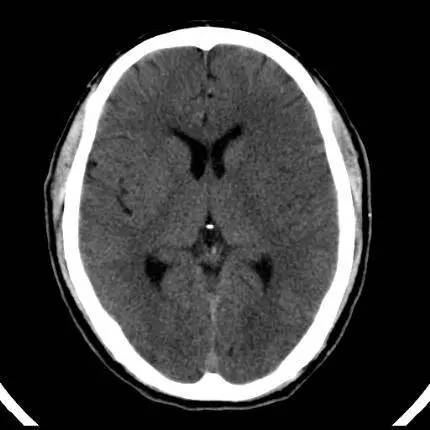 脑梗死的五大ct影像征象,请关注!