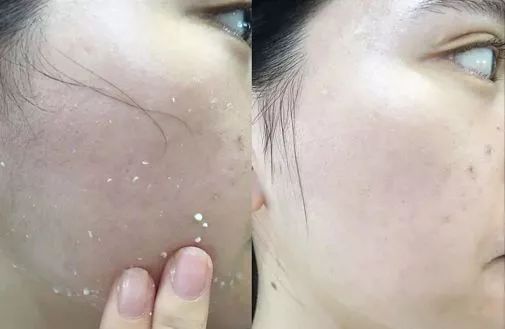 就像是肌肤的橡皮擦一般,老化角质去掉后,黑色素正常代谢,使用后皮肤