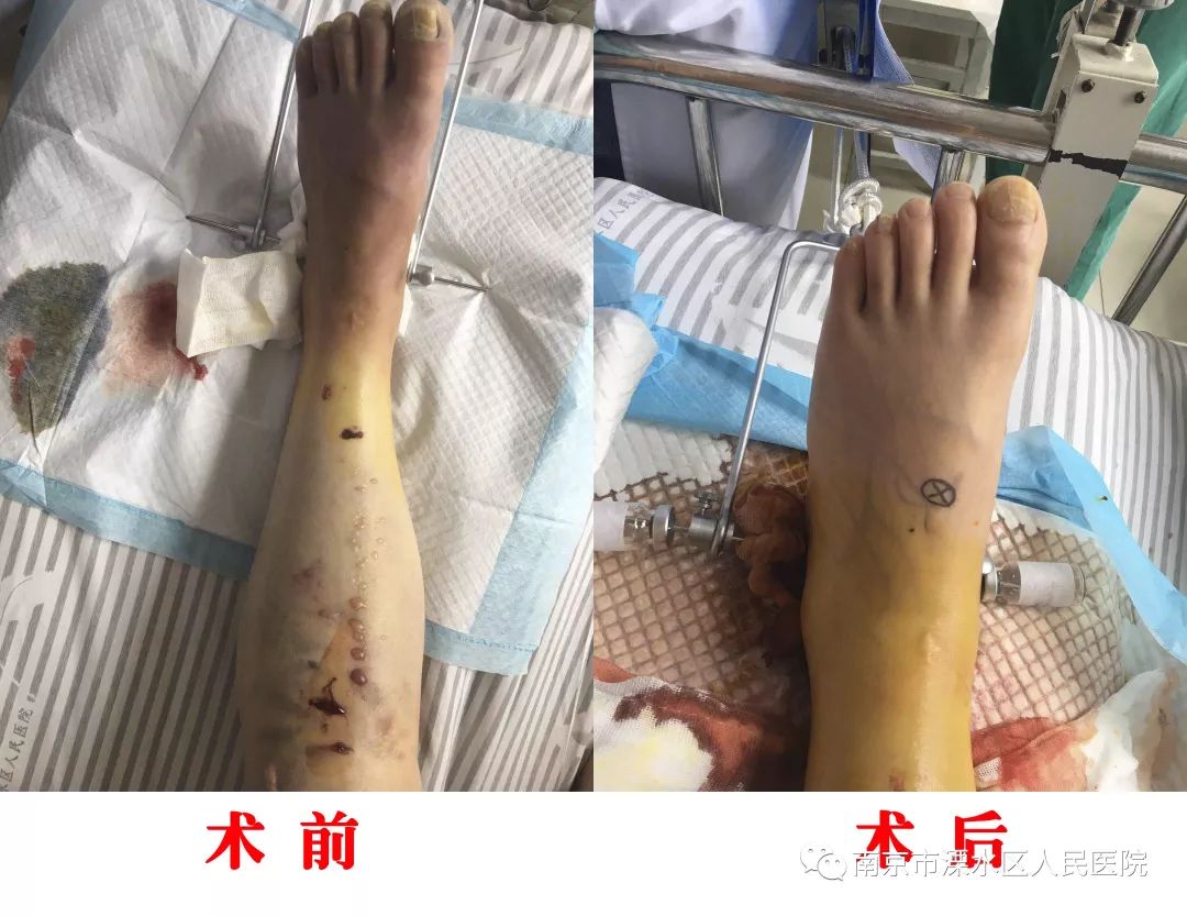 骨折后的冷血杀手骨筋膜室综合征