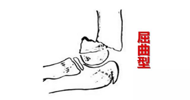 儿童最常见的骨折原来是肱骨髁上骨折怎样最容易受伤