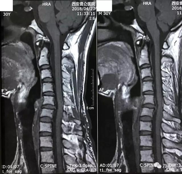 颈椎mri t1相:颈椎反曲,颈5-6椎间盘突出进入椎管,椎管狭窄,压迫妓梃