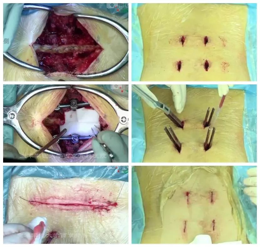 经皮椎弓根螺钉技术治疗胸腰椎骨折:为后路微创手术,切口小,仅需4个约