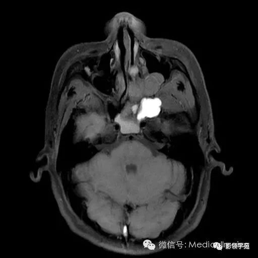 筛窦恶性肿瘤图片