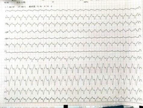 avr 导联判断电轴方向无人区电轴是指心电图的额面电轴位于 -90~±180