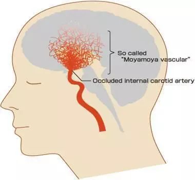 煙霧病其實是一組閉塞性腦血管疾病,臨床上並不常見,但嚴重威脅著人們