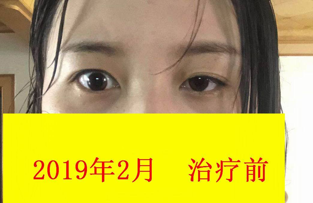 甲亢突眼治療新案例--治療一月後對照 (原創)_第五醫院