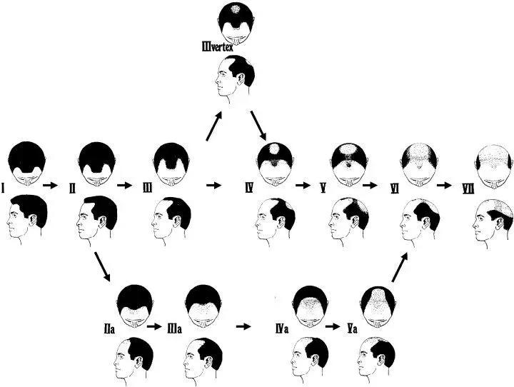 男生大量掉头发的原因(男孩子掉头发是什么原因引起的)