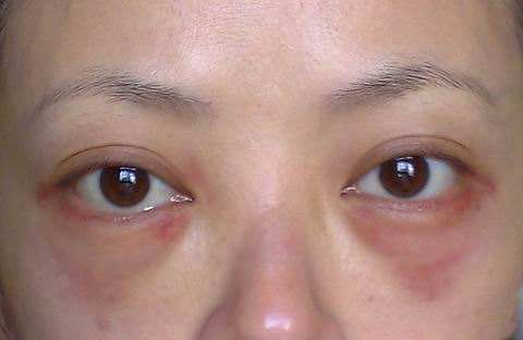 做眼袋手术硬结正常吗?acme-te-a细胞科技如何规避风险?