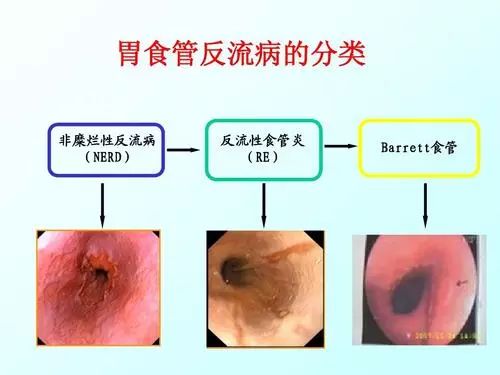 善於偽裝的胃食管反流病,70多種病與它相關