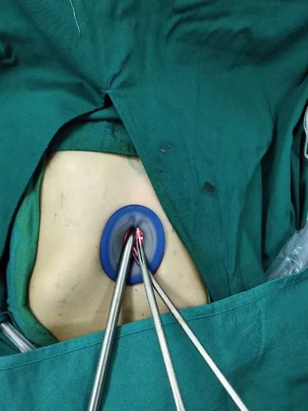 胸外科手术还能这样做呀