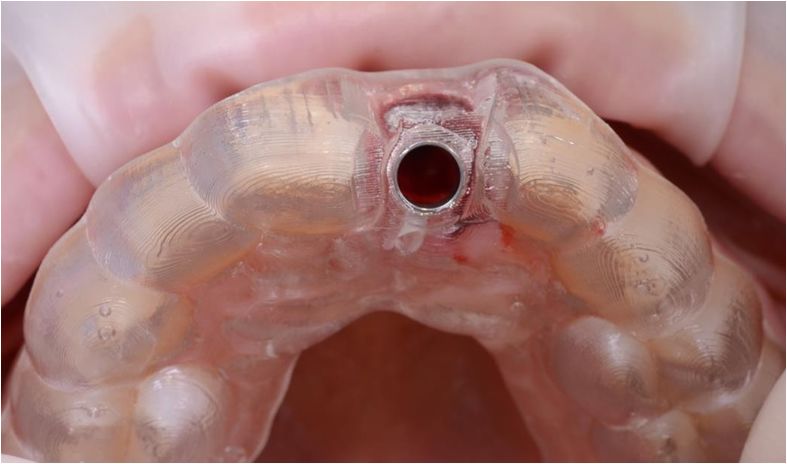 试戴种植导板清理拔牙窝,清除肉芽组织.非创伤性清除剩余牙根结构.