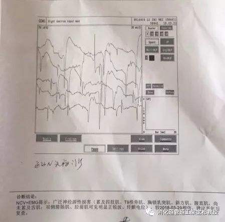 渐冻症肌电图表现图片