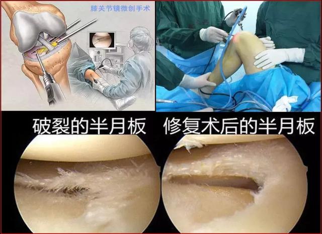 共振报告的结果三方面都符合半月板损伤的诊断,才能判断是否应该手术