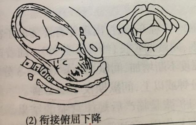 动作解析 胎头取半俯屈状态以枕额径进入骨盆入口