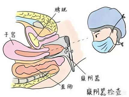 對於婦科篩查,tct&hpv應該如何選擇?_檢查