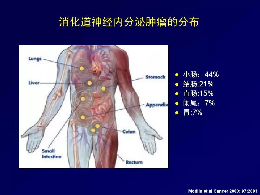 胰腺神经内分泌瘤(pnet)那什么是神经内分泌肿瘤呢江苏省人民医院