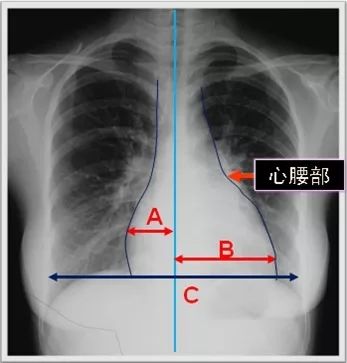 诊断 靴型心 梨形心 普大型心脏 正常心脏 以上均不是病史