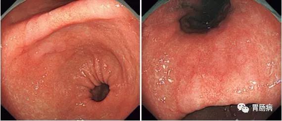 原创治疗萎缩性胃炎,中成药或是一个新途径