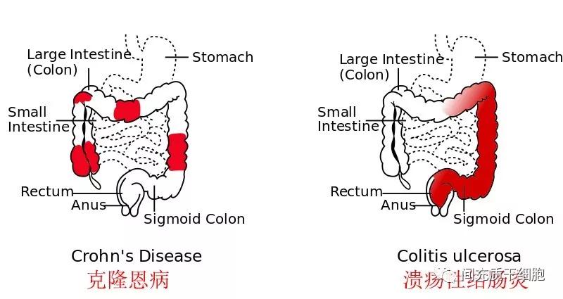 幹細胞將是治療克隆恩病的首選良藥_克羅恩