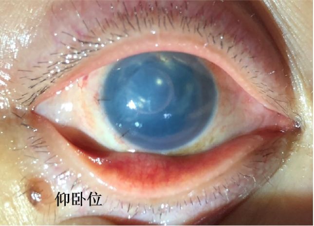 坐位无气泡, 鼻侧及下方见双前房右眼fs-dsek术后2019-01-08 右眼角膜