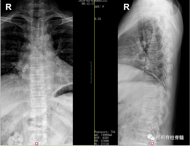 腰痛背痛难忍!"生命支柱"遭遇结核杆菌,"脊柱结核"你听说过吗?