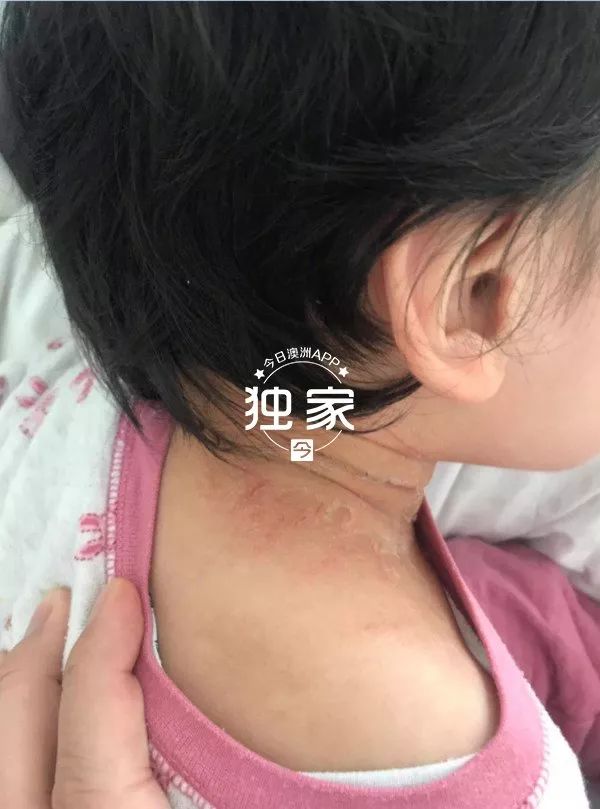 "3岁华裔男童澳洲幼儿园内遭严重烫伤!