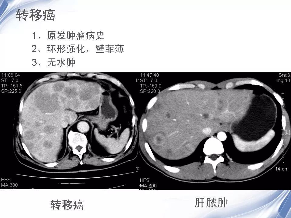 肝脓肿影像图片