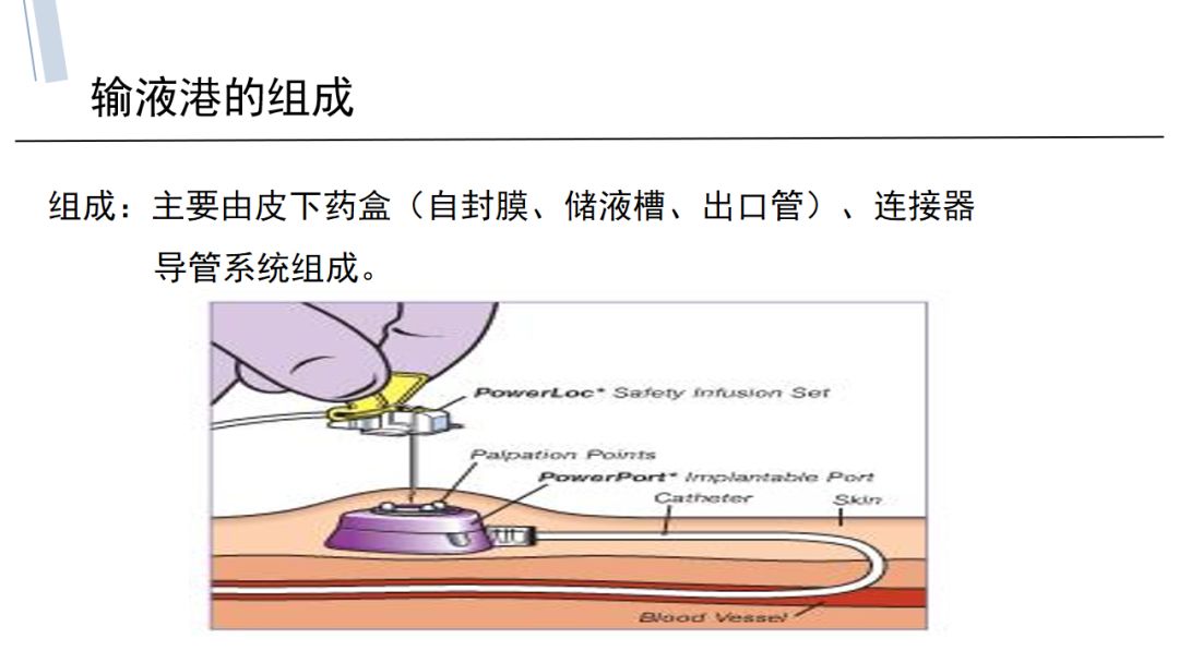 输液港固定图片与方法图片