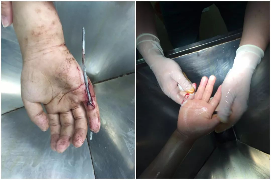 疼平原县一8岁男童被10厘米铁丝穿透手指