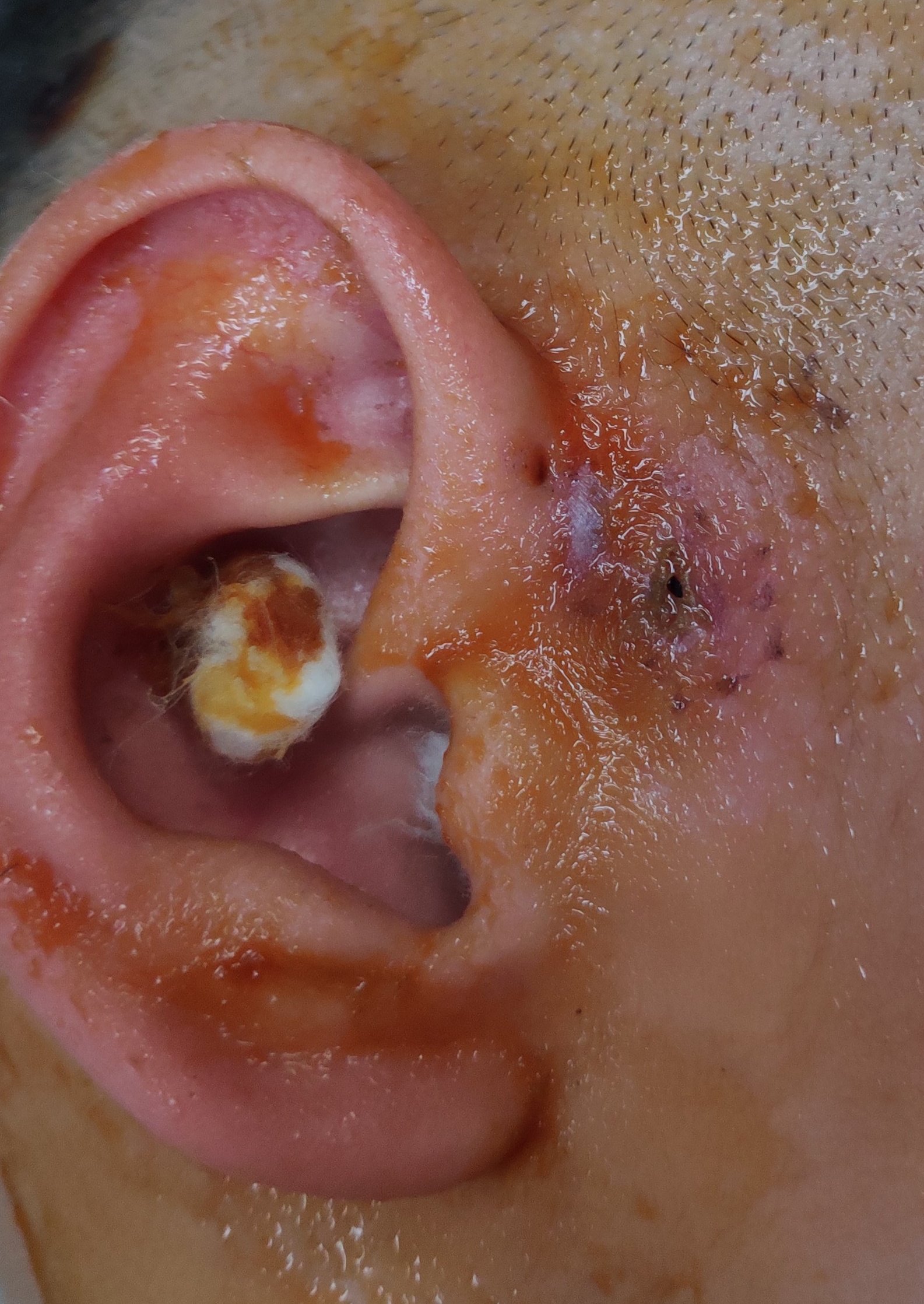 2岁患儿,耳前瘘管反复感染瘘管连同感染坏死组织整体切除