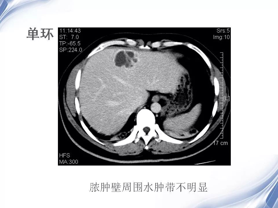 细菌性肝脓肿的影像诊断影像天地