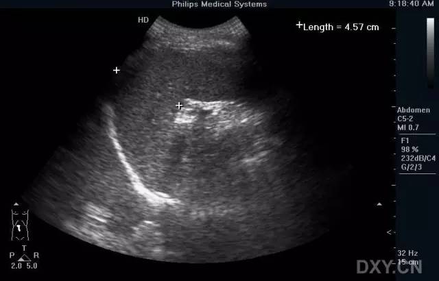脾静脉超声图图片