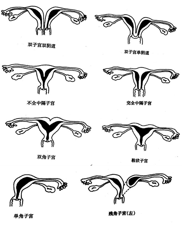 子宫畸形包括:先天性无子宫,子宫发育不良(幼稚子宫,双子宫,双角子宫