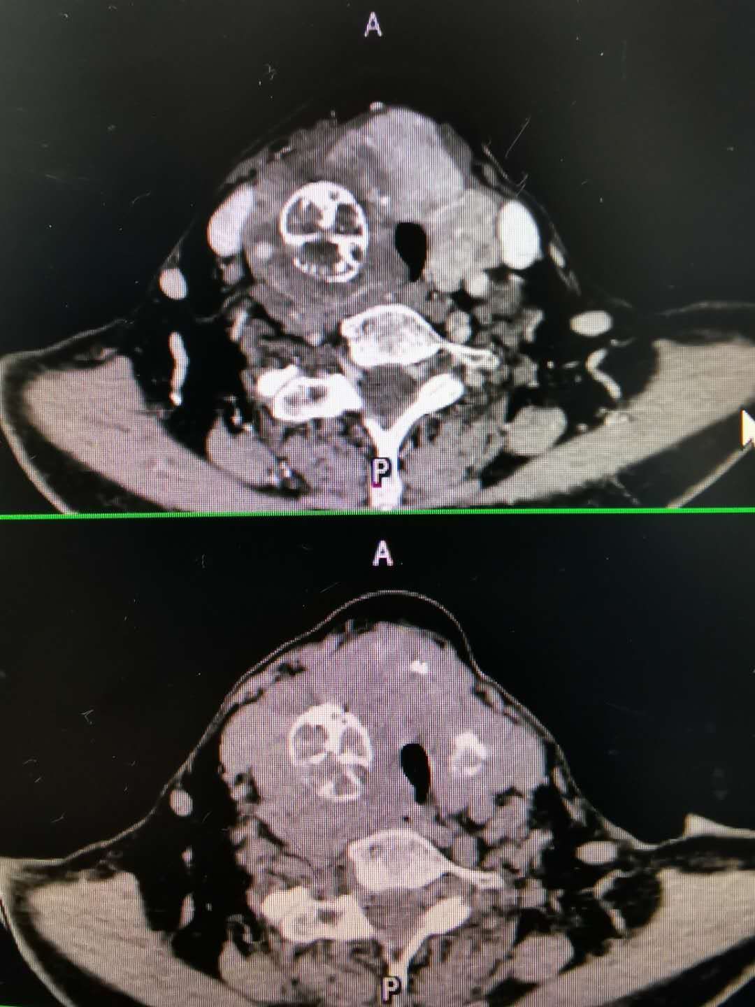 甲状腺良性肿瘤恶变甲状腺未分化癌1例原创