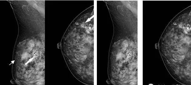 乳腺9大基本病变从业人员必须掌握的基础