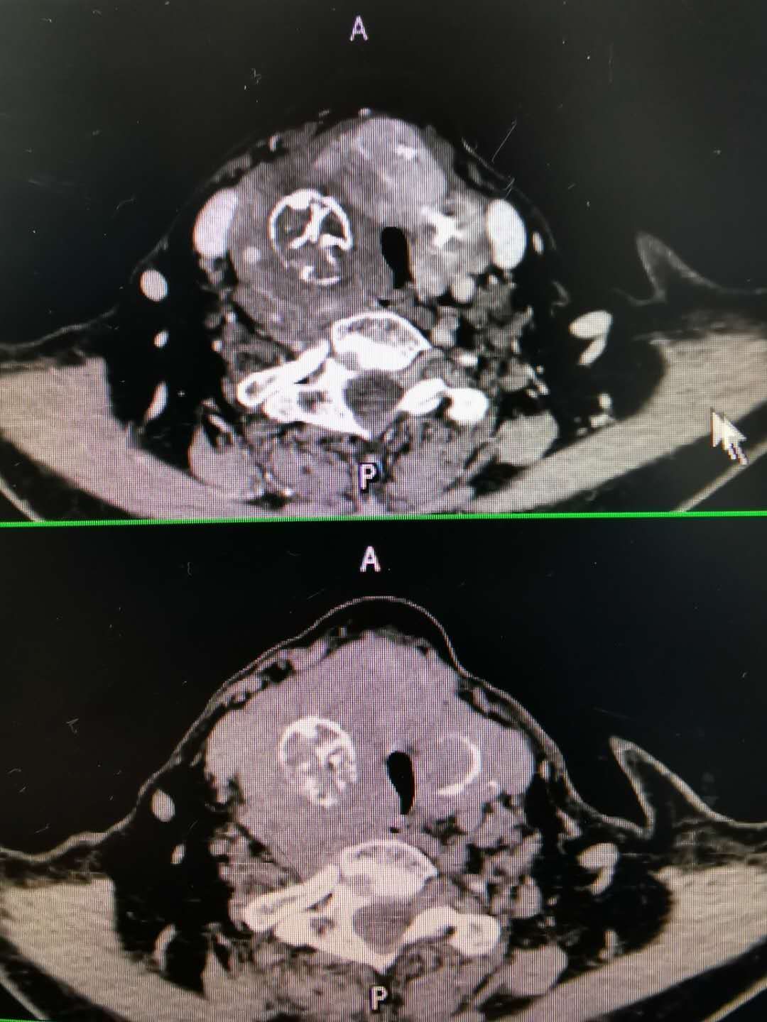 甲状腺良性肿瘤恶变甲状腺未分化癌1例原创