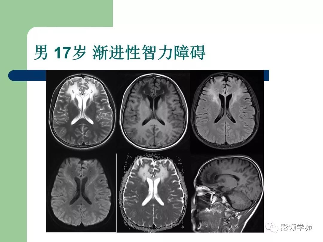 【经典】磁共振临床应用——脑实质篇_线圈