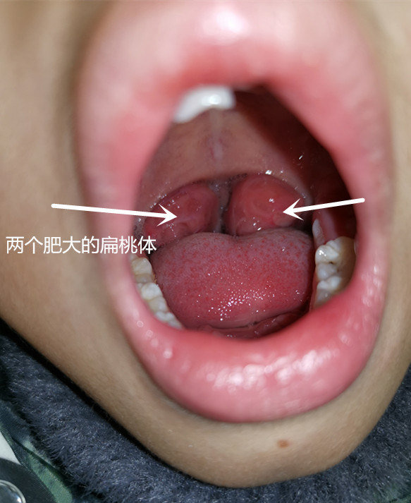 喉咙两侧的肉球图片图片