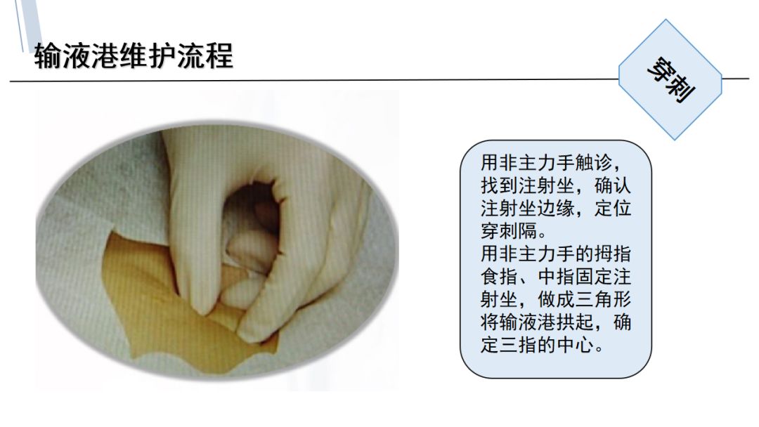 输液港的应用与维护