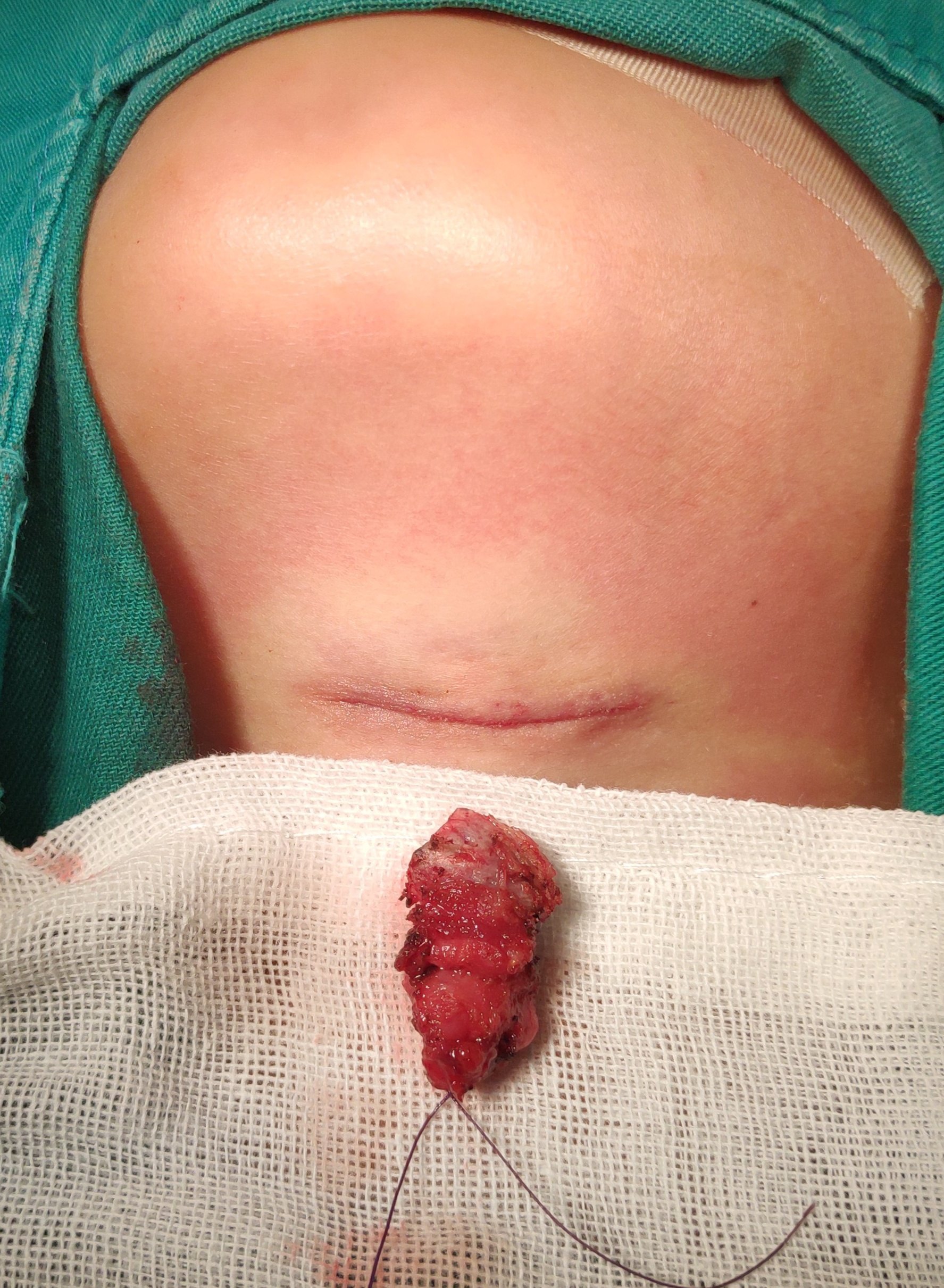 甲舌囊肿手术图片