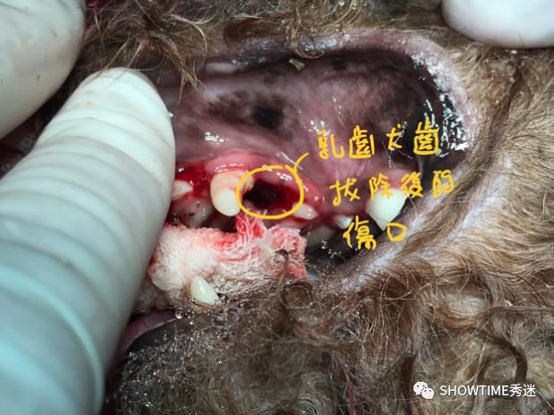 拔除乳齿后的伤口进行翻瓣治疗与瘘管修补修补手术完成后鼻子"漏"水的