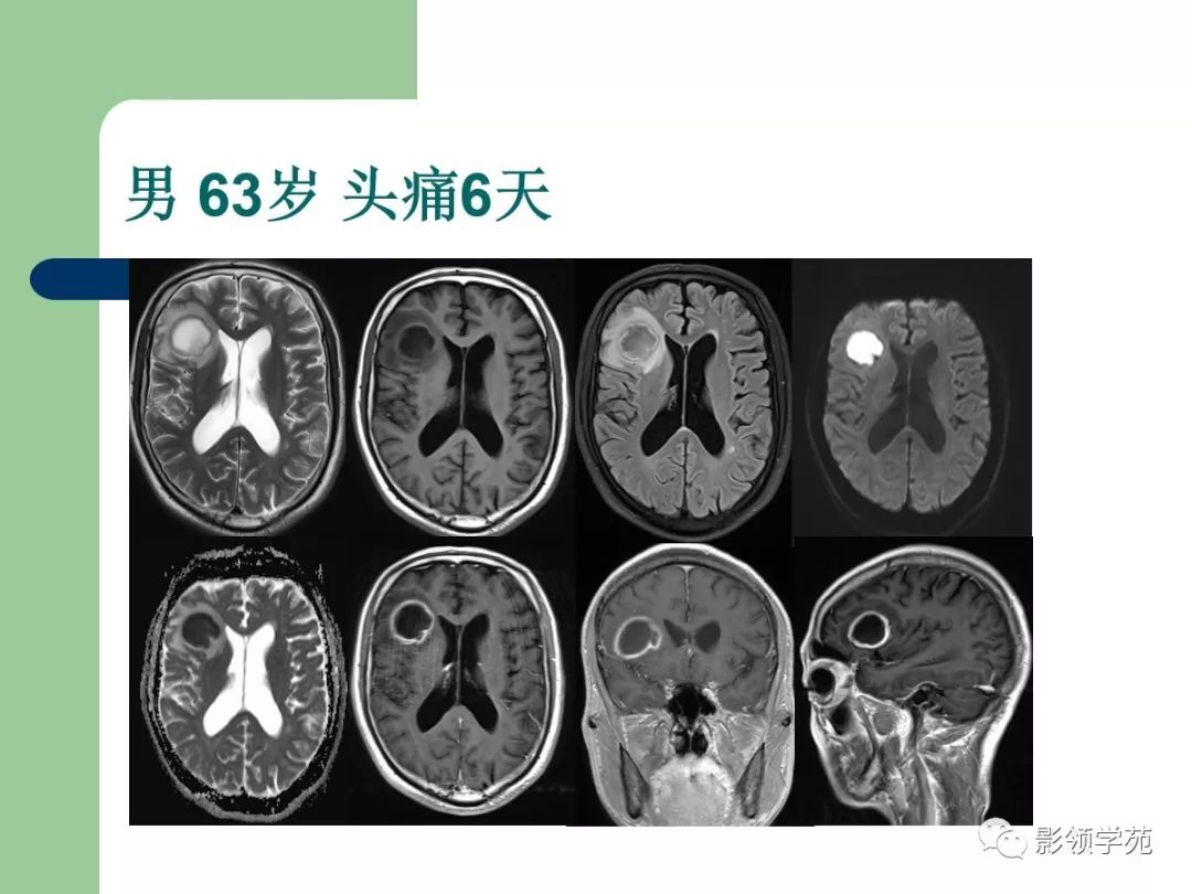 經典磁共振臨床應用腦實質篇