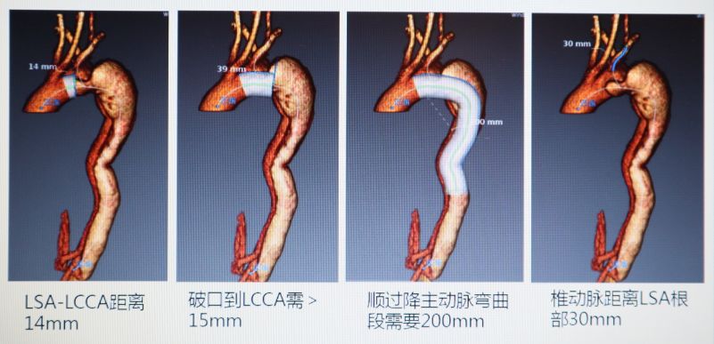 主动脉夹层烟囱支架图片