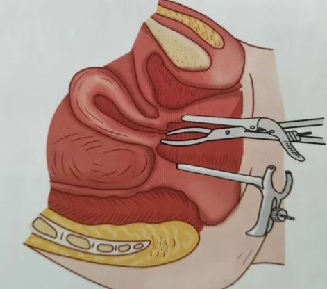 子宫脱垂手术步骤图解图片