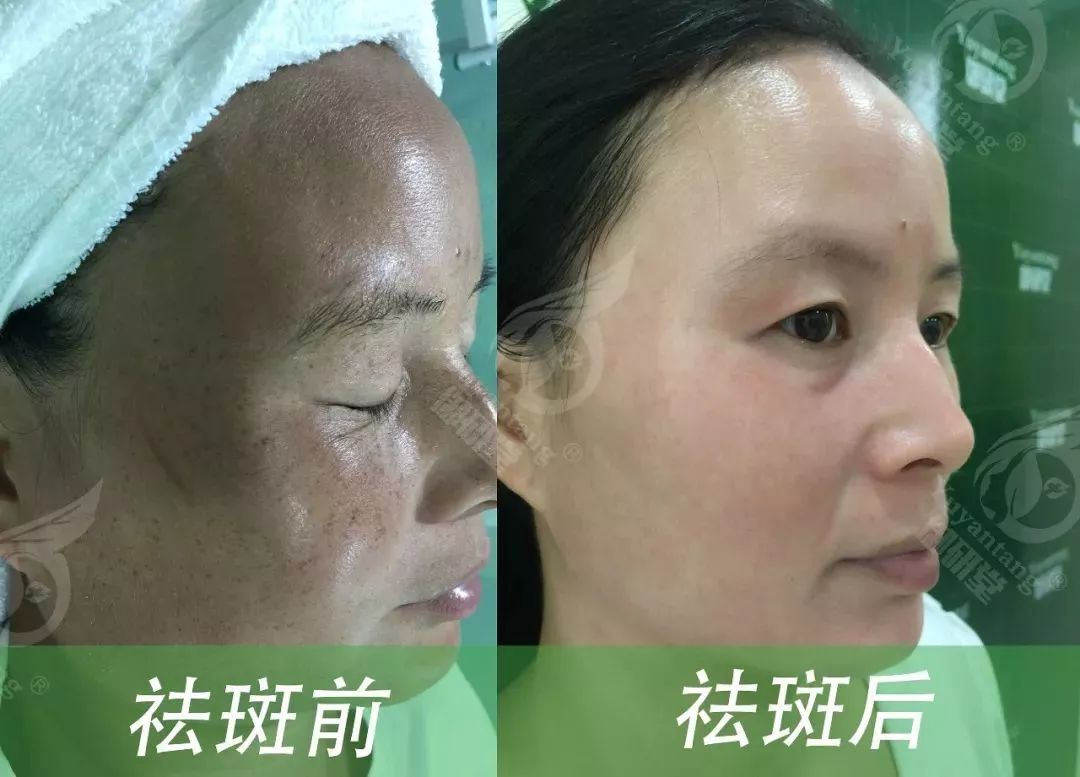 生物酶酵素提取分解技术 它最厉害的地方就是 可以分斑分治,科学祛斑
