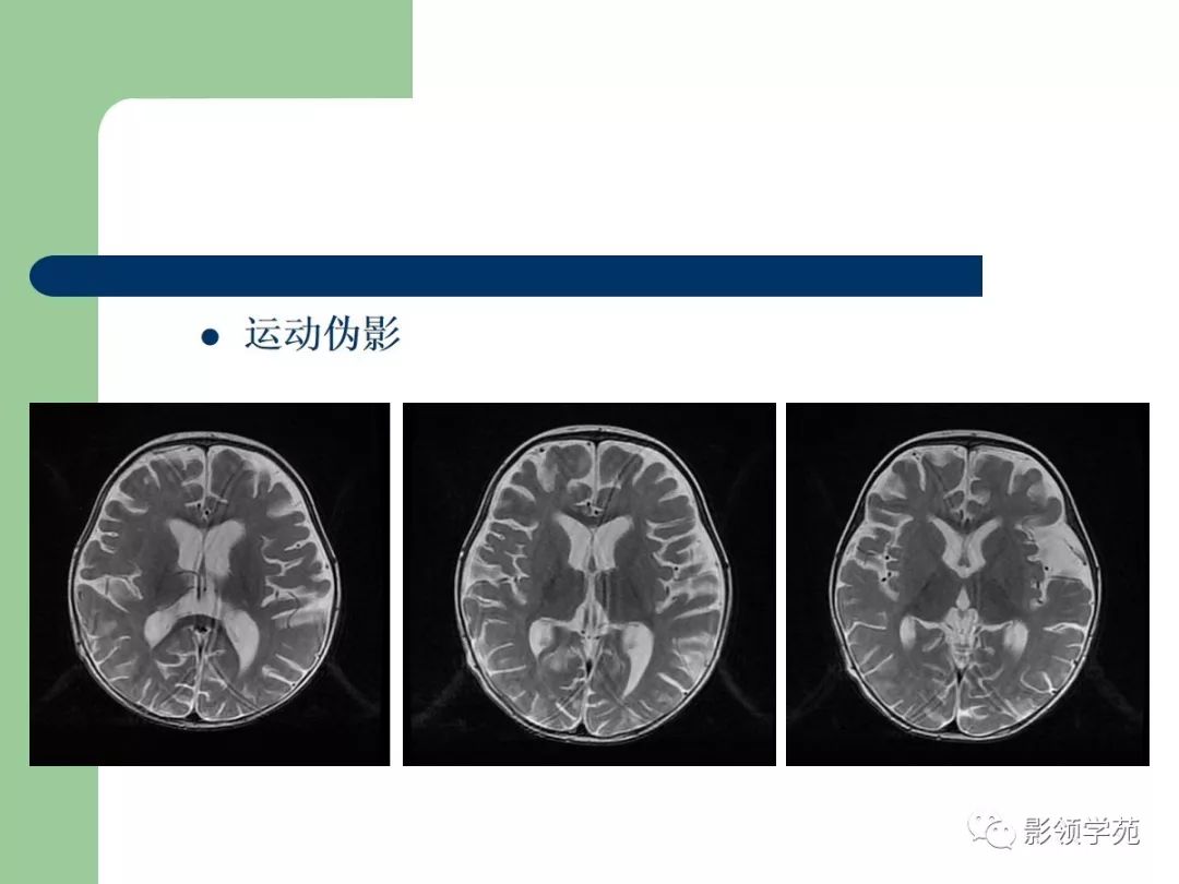 经典磁共振临床应用脑实质篇