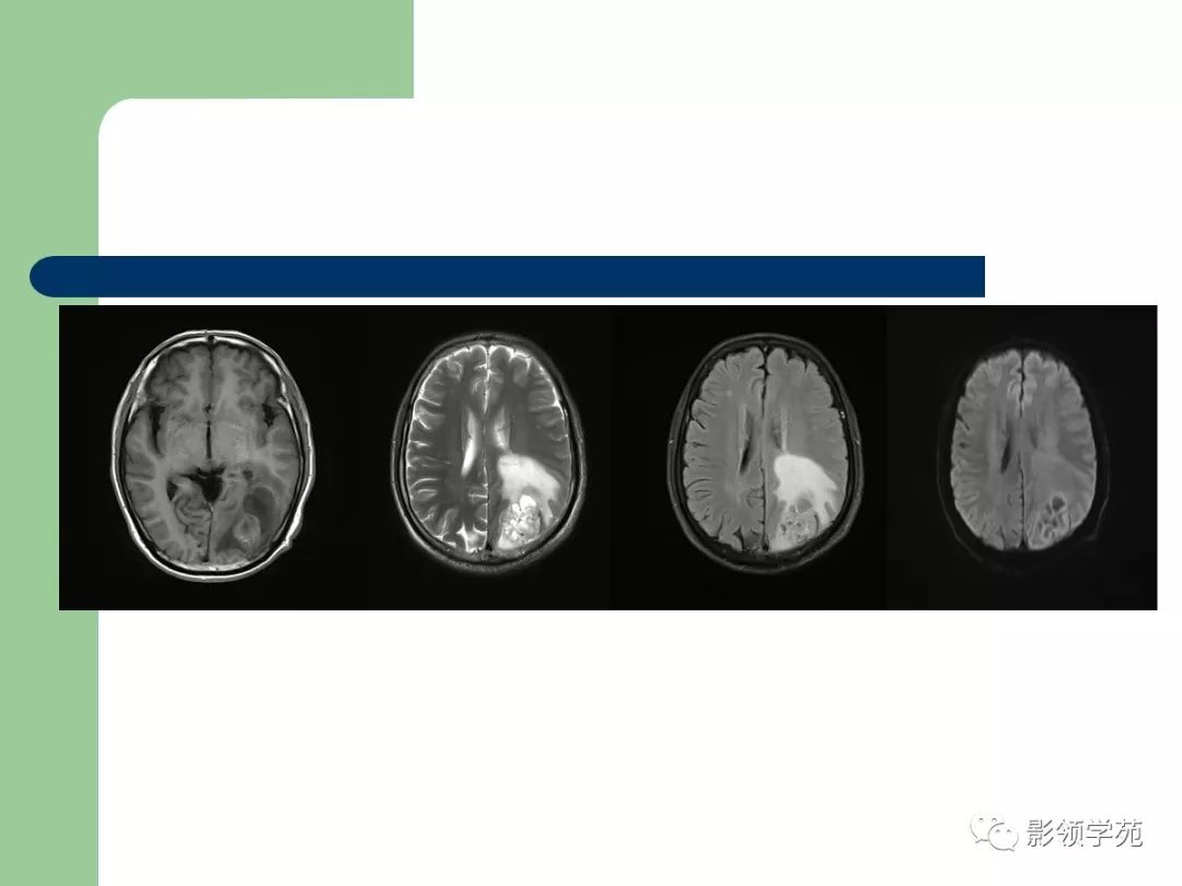 經典磁共振臨床應用腦實質篇