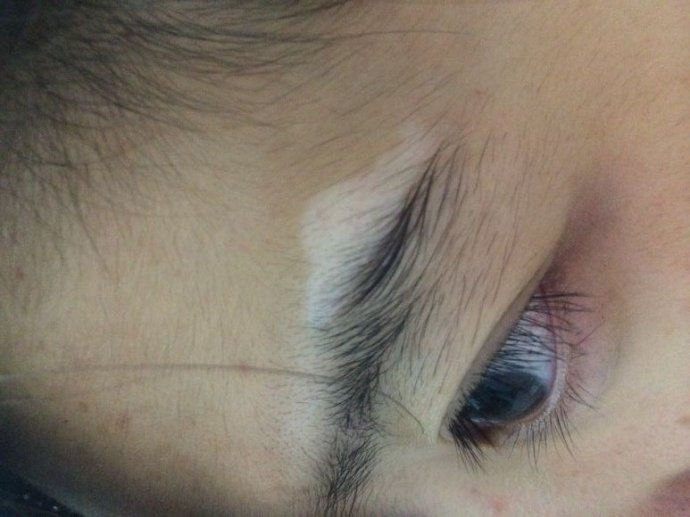 在身上发现了一块指甲大小的白癜风好不好治